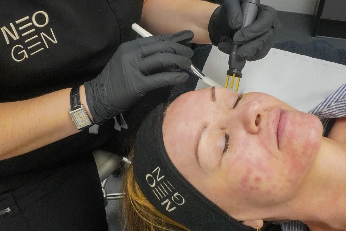 Neogen facial treatment beside the plasma device — iCRYO Westminster, CO wellness guide