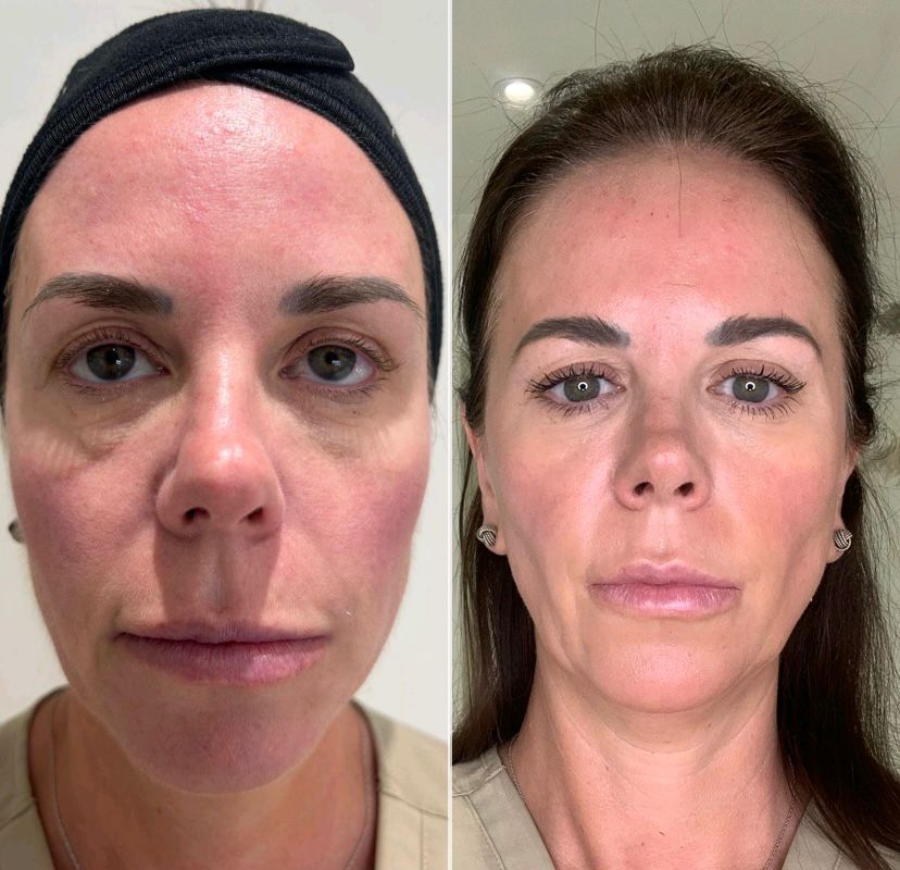 Neogen Face Lift results — One Treatment