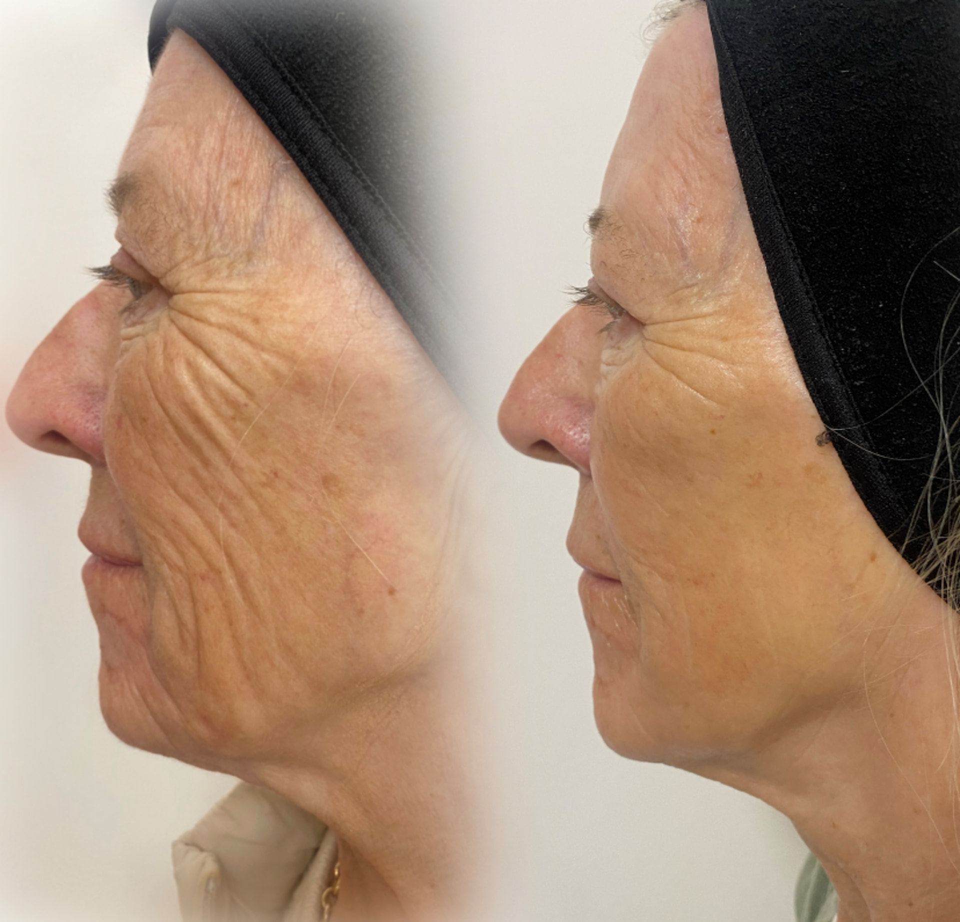 Neogen Face Lift results — Two Treatments