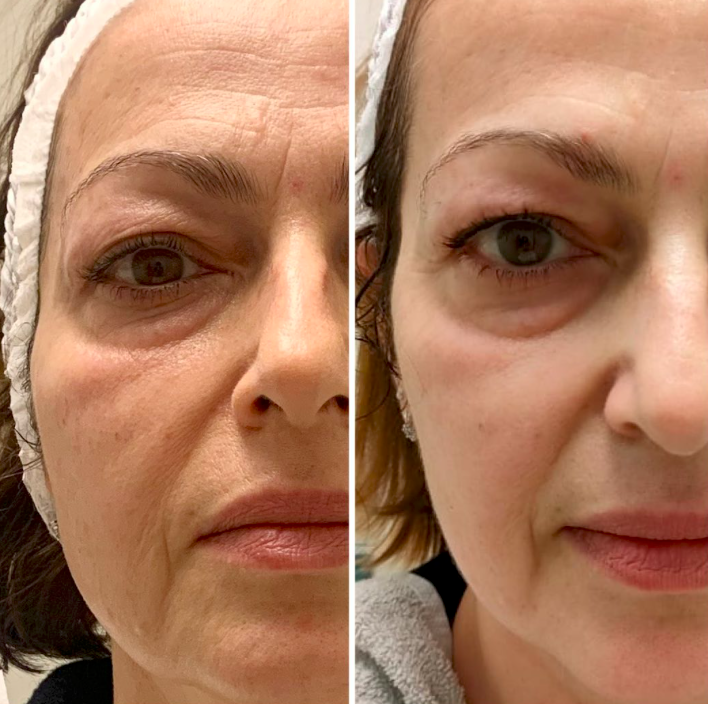 Eye & Cheek Area before and after results