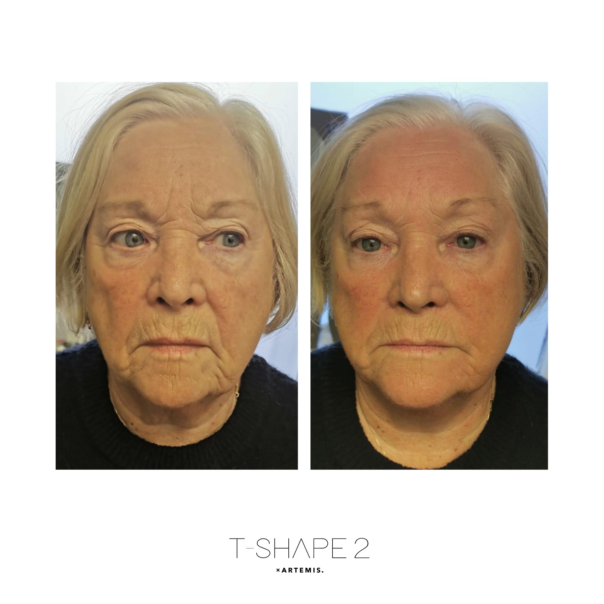 Face After 1 treatment