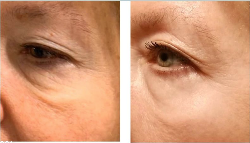 Neogen Face Lift results — Around The Eyes