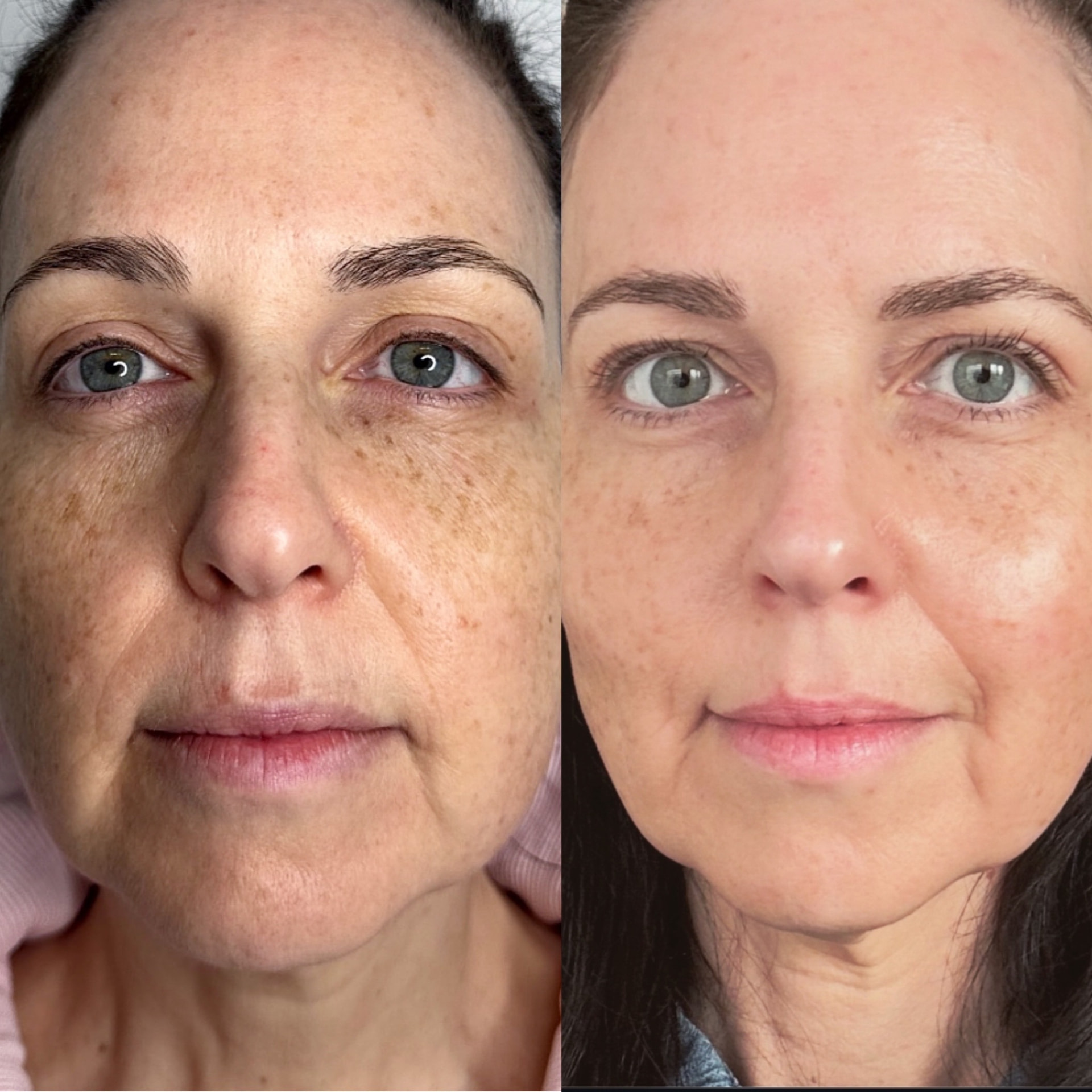 Neogen Face Lift results — Texture & Tone — Two Weeks Post-Treatment