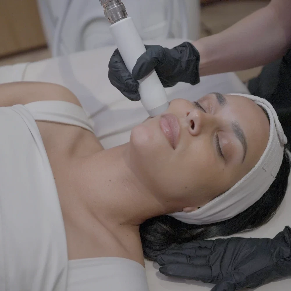 T-Shape 2 facial treatment on the cheek at iCRYO Westminster